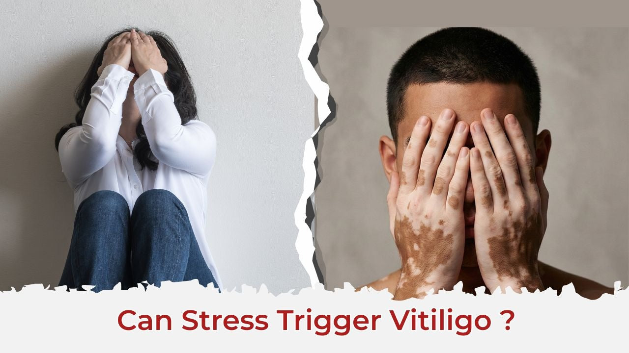 Can Stress Trigger Vitiligo? Understanding the Mind–Skin Connection